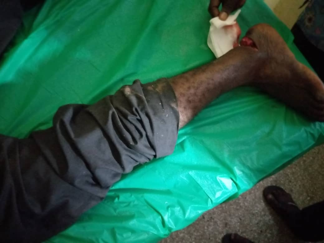 E/R: Flying Roofing Sheet Cuts Ankle of “Loading Boy