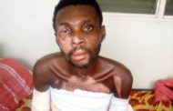 E/R: Epilepsy Man Falls into Naked Fire, Family Appeals for Financial Support