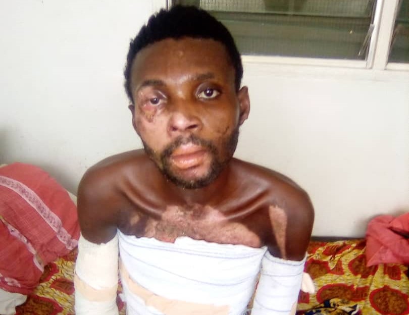 E/R: Epilepsy Man Falls into Naked Fire, Family Appeals for Financial Support