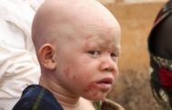 Allow Albino Students to Sit Closer to Teaching Boards, Print Textbooks in Large Font - Albinos in Ghana