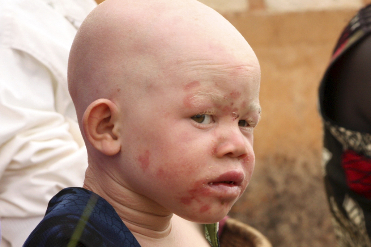 Allow Albino Students to Sit Closer to Teaching Boards, Print Textbooks in Large Font - Albinos in Ghana