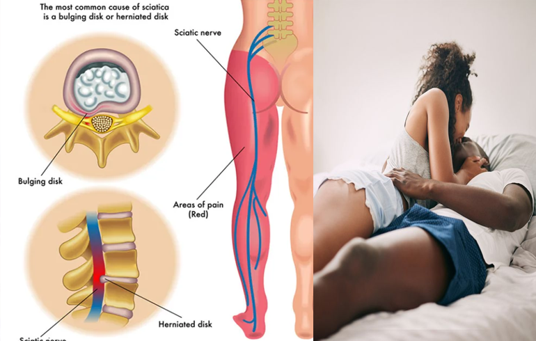 Sex Is The Ultimate Treatment For Sciatica – Sciatica Expert