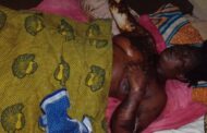 C/R: Woman Losing Sight after Acid Attack by Jilted Boyfriend