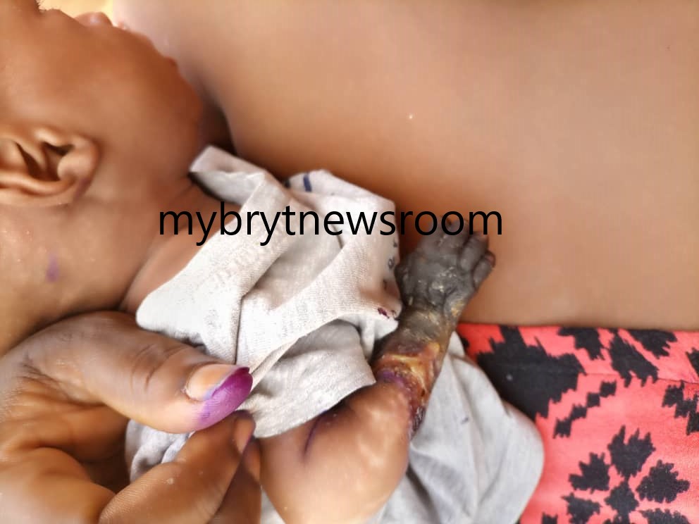 Akwatia: Baby's Hand Left to Rot at St. Dominic Hospital over Medical Negligence