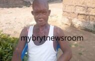E/R: Man Attacked With Acid by Wife Accuses Police of Not Showing Interest
