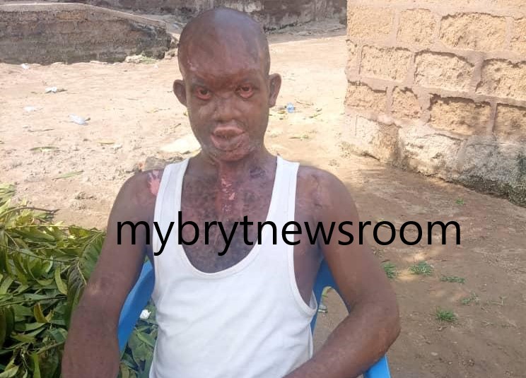 E/R: Man Attacked With Acid by Wife Accuses Police of Not Showing Interest