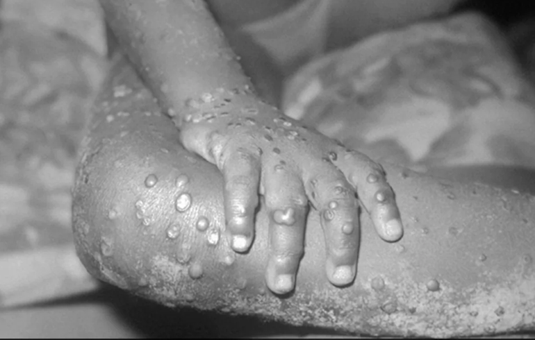 Health Facts: Monkeypox, What You Need To Know About The Deadly Disease