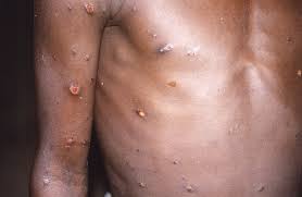 Eastern Region Records Monkeypox Disease