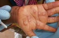 E/R: Afram Plains, Birim North Record 3 Suspected Cases of Monkey Pox