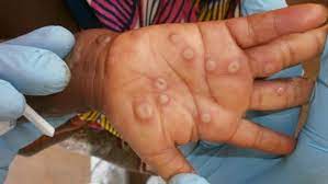 E/R: Afram Plains, Birim North Record 3 Suspected Cases of Monkey Pox