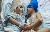 Conjoined Twins Separated With the Help of Virtual Reality