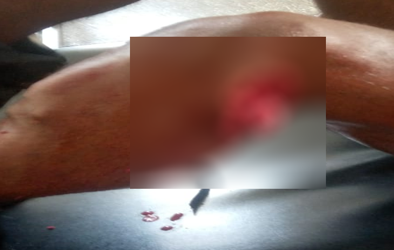 Koforidua: Doctors Amputate Leg Of Akropong Chieftaincy Shooting Incident