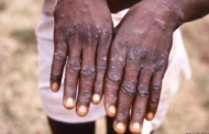 Monkeypox And Smallpox Vaccine Clinical Study To Be Done In Kenya In 2023