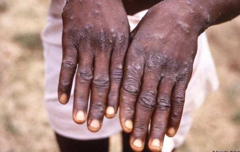 Monkeypox And Smallpox Vaccine Clinical Study To Be Done In Kenya In 2023