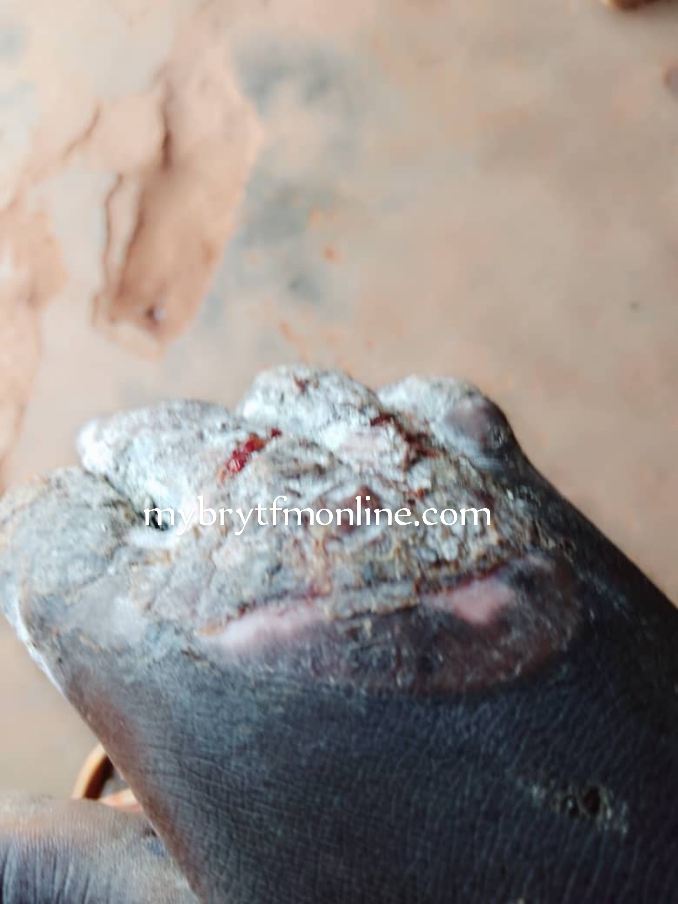 E/R: JHS Graduate Hospitalised After Pastor Burnt His Palm And Fingers 'Spiritually' Over Ghc600 Missing Money