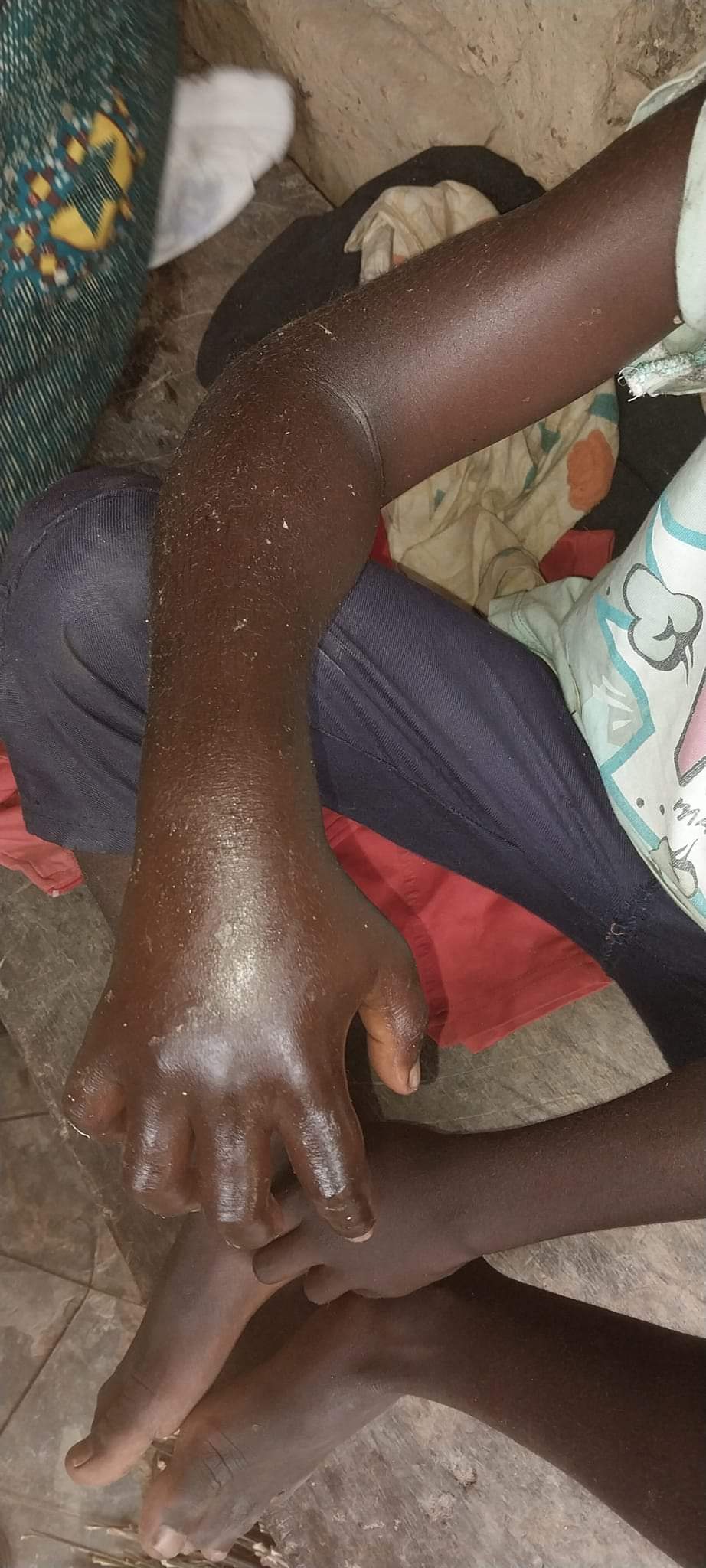 C/R: Health Of Boy Bitten By Snake Deteriorating As Parents Fail To Seek Treatment Due To Lack Of Cash