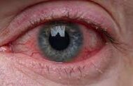 What You Need To Kow About Pink Eye (Apollo)