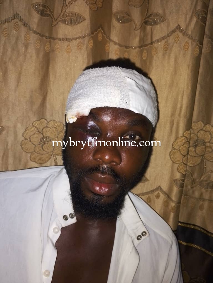 Koforidua: Butcher Struggling For His One Eye After Attack By A Nigerian