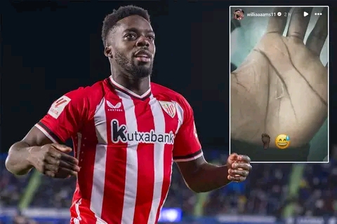 Inaki Williams Undergone Surgery To Remove A Two-Centimeter Glass In The Sole Of His Foot