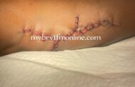 Kyebi Shooting Incident: Victim Undergoes Surgery As Youth Allege GH¢80,000 Payment To Soldiers